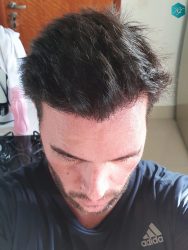 Injerto Capilar Técnica FUE Grafts 3223 (9295 Pelos) 45 RESULTADOS EN 12 MESES