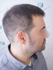 Injerto Capilar Técnica FUE 6557 Grafts (14215 Pelos) 49 57 EN 3 MESES