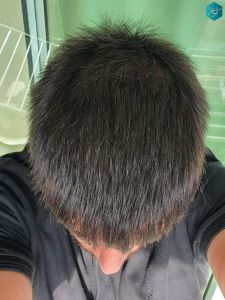 Injerto Capilar Técnica FUE Grafts 3223 (9295 Pelos) 49 RESULTADOS EN 12 MESES