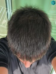 Injerto Capilar Técnica FUE Grafts 3223 (9295 Pelos) 46 RESULTADOS EN 12 MESES