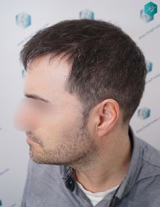 Injerto Capilar Técnica FUE 6557 Grafts (14215 Pelos) 50 58 EN 3 MESES