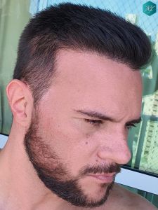 Injerto Capilar Técnica FUE Grafts 3223 (9295 Pelos) 50 RESULTADOS EN 12 MESES