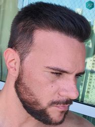 Injerto Capilar Técnica FUE Grafts 3223 (9295 Pelos) 47 RESULTADOS EN 12 MESES