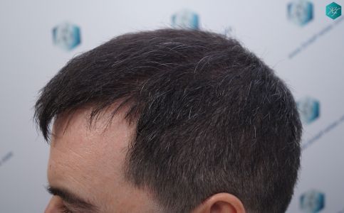 Injerto Capilar Técnica FUE 6557 Grafts (14215 Pelos) 51 59 EN 3 MESES