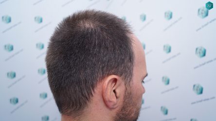 Injerto Capilar Técnica FUE Grafts 3223 (9295 Pelos) 6 ANTES DEL TRASPLANTE CAPILAR