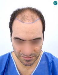 DISEÑO LÍNEA INJERTO CAPILAR DISEÑO LÍNEA INJERTO CAPILAR