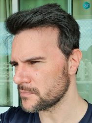 Injerto Capilar Técnica FUE Grafts 3223 (9295 Pelos) 48 RESULTADOS EN 12 MESES