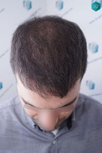 Injerto Capilar Técnica FUE 6557 Grafts (14215 Pelos) 52 60 EN 3 MESES