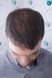 Injerto Capilar Técnica FUE 6557 Grafts (14215 Pelos) 50 60 EN 3 MESES