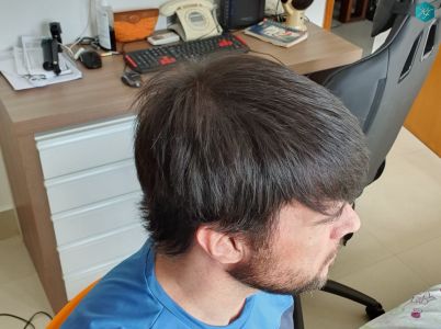 Injerto Capilar Técnica FUE Grafts 3223 (9295 Pelos) 52 RESULTADOS EN 12 MESES