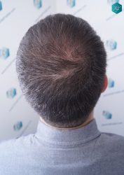 Injerto Capilar Técnica FUE 6557 Grafts (14215 Pelos) 51 61 EN 3 MESES