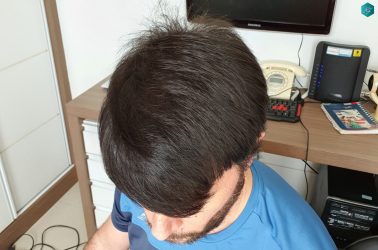 Injerto Capilar Técnica FUE Grafts 3223 (9295 Pelos) 50 RESULTADOS EN 12 MESES
