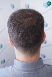 Injerto Capilar Técnica FUE 6557 Grafts (14215 Pelos) 54 62 EN 3 MESES