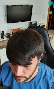 Injerto Capilar Técnica FUE Grafts 3223 (9295 Pelos) 54 RESULTADOS EN 12 MESES
