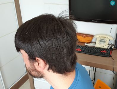 Injerto Capilar Técnica FUE Grafts 3223 (9295 Pelos) 55 RESULTADOS EN 12 MESES