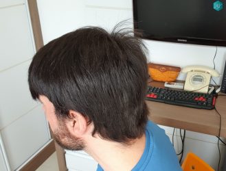 Injerto Capilar Técnica FUE Grafts 3223 (9295 Pelos) 52 RESULTADOS EN 12 MESES