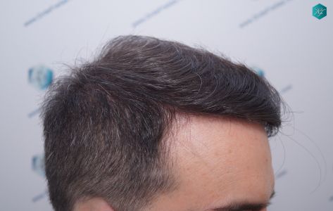 Injerto Capilar Técnica FUE 6557 Grafts (14215 Pelos) 55 65 EN 12 MESES 1