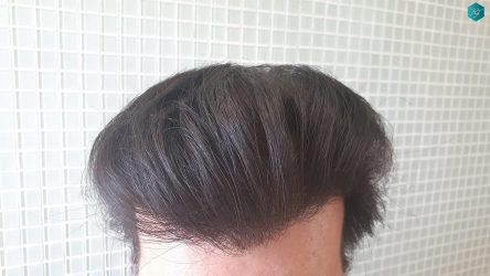 Injerto Capilar Técnica FUE Grafts 3223 (9295 Pelos) 53 RESULTADOS EN 12 MESES