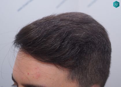 Injerto Capilar Técnica FUE 6557 Grafts (14215 Pelos) 56 66 EN 12 MESES 1