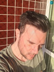 Injerto Capilar Técnica FUE Grafts 3223 (9295 Pelos) 54 RESULTADOS EN 12 MESES