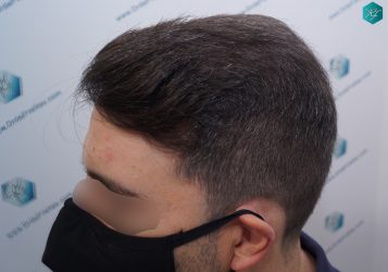 Injerto Capilar Técnica FUE 6557 Grafts (14215 Pelos) 55 67 EN 12 MESES 1