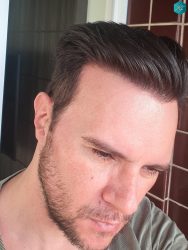 Injerto Capilar Técnica FUE Grafts 3223 (9295 Pelos) 55 RESULTADOS EN 12 MESES