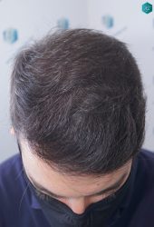 Injerto Capilar Técnica FUE 6557 Grafts (14215 Pelos) 56 68 EN 12 MESES 1