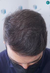 Injerto Capilar Técnica FUE 6557 Grafts (14215 Pelos) 58 68 EN 12 MESES 1