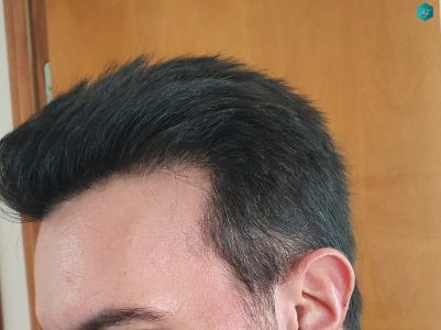 Injerto Capilar Técnica FUE Grafts 3223 (9295 Pelos) 59 RESULTADOS EN 12 MESES