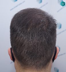Injerto Capilar Técnica FUE 6557 Grafts (14215 Pelos) 57 69 EN 12 MESES 1