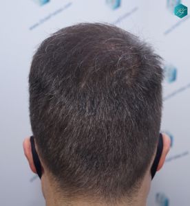 Injerto Capilar Técnica FUE 6557 Grafts (14215 Pelos) 59 69 EN 12 MESES 1