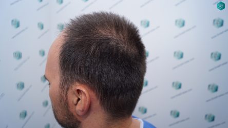 Injerto Capilar Técnica FUE Grafts 3223 (9295 Pelos) 7 ANTES DEL TRASPLANTE CAPILAR