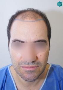 Injerto Capilar Técnica FUE 6557 Grafts (14215 Pelos) 5 7 DISEÑO