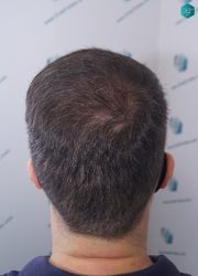 Injerto Capilar Técnica FUE 6557 Grafts (14215 Pelos) 58 72 EN 12 MESES