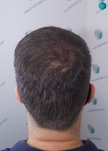 Injerto Capilar Técnica FUE 6557 Grafts (14215 Pelos) 60 72 EN 12 MESES