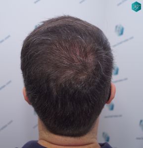 Injerto Capilar Técnica FUE 6557 Grafts (14215 Pelos) 61 73 EN 12 MESES