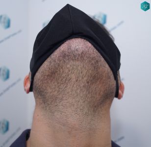 Injerto Capilar Técnica FUE 6557 Grafts (14215 Pelos) 62 74 EN 12 MESES