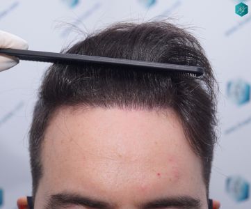 Injerto Capilar Técnica FUE 6557 Grafts (14215 Pelos) 63 76 EN 12 MESES