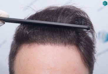 Injerto Capilar Técnica FUE 6557 Grafts (14215 Pelos) 62 77 EN 12 MESES