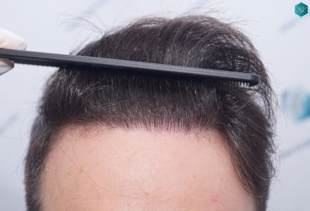 Injerto Capilar Técnica FUE 6557 Grafts (14215 Pelos) 64 77 EN 12 MESES