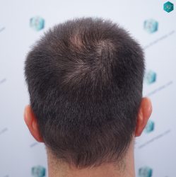 Injerto Capilar Técnica FUE Grafts 3223 (9295 Pelos) 8 DISEÑO LINEA INJERTO CAPILAR