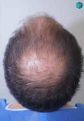 Injerto Capilar Técnica FUE 6557 Grafts (14215 Pelos) 6 8 DISEÑO