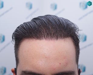 Injerto Capilar Técnica FUE 6557 Grafts (14215 Pelos) 63 80 EN 12 MESES