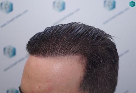Injerto Capilar Técnica FUE 6557 Grafts (14215 Pelos) 66 82 EN 12 MESES