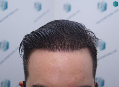 Injerto Capilar Técnica FUE 6557 Grafts (14215 Pelos) 67 84 EN 12 MESES