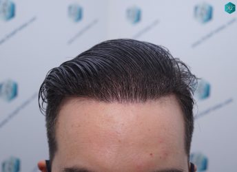 Injerto Capilar Técnica FUE 6557 Grafts (14215 Pelos) 65 84 EN 12 MESES