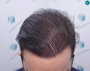 Injerto Capilar Técnica FUE 6557 Grafts (14215 Pelos) 66 86 EN 12 MESES