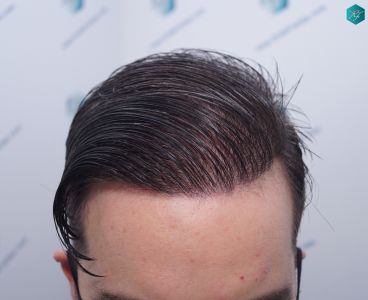 Injerto Capilar Técnica FUE 6557 Grafts (14215 Pelos) 69 87 EN 12 MESES