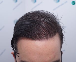 Injerto Capilar Técnica FUE 6557 Grafts (14215 Pelos) 67 87 EN 12 MESES