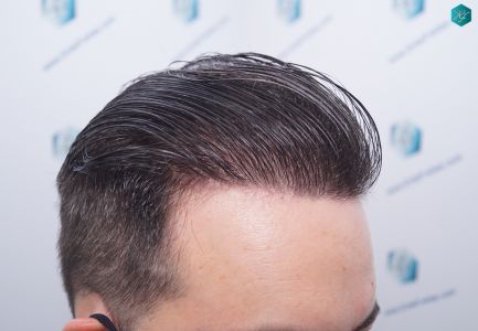 Injerto Capilar Técnica FUE 6557 Grafts (14215 Pelos) 70 88 EN 12 MESES